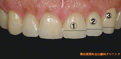 歯のゴールデンプロポーション